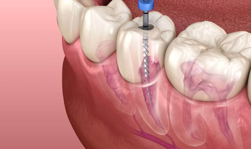 Does a Root Canal Really Hurt?